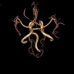 左侧大脑后动脉开窗畸形图片,脑部基底动脉开窗畸形如何治疗