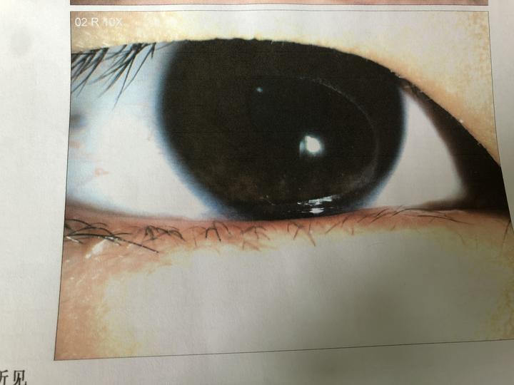 消毒酒精误喷到小孩眼睛,消毒液误入眼睛怎么办