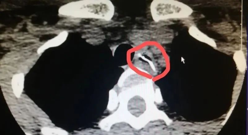 凶险！一口气喝完鱼汤后胸口刺痛！没想到竟需要8个科室10多位专家联手……