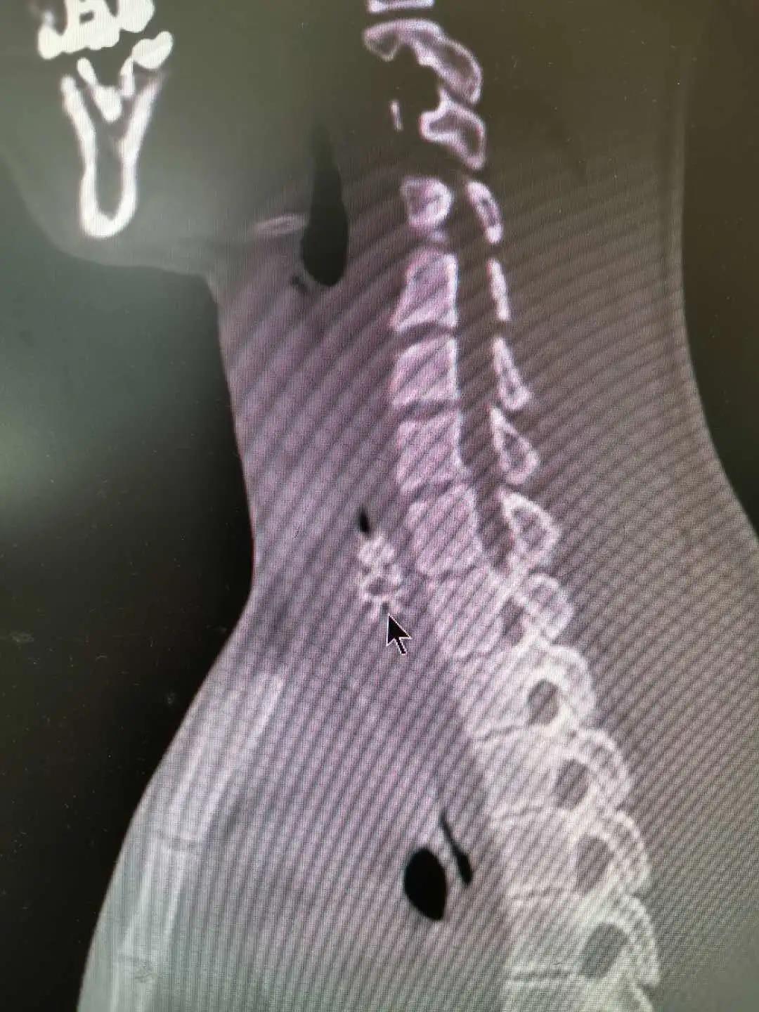 天呐,老人喝粥老是噎住