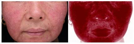 最近的脸又痒、又红、还发烫，华西专家说，你多半是遭了敏感性皮肤了！