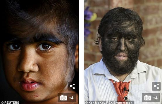 可怕！西班牙17名儿童全身长满毛，根源竟然是这种药