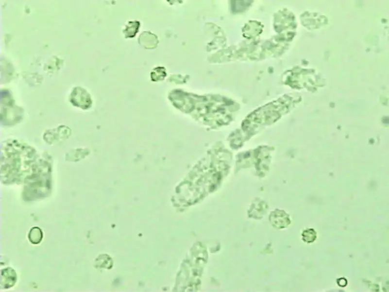 尿液中的有形成分红细胞,尿液中常见的有形成分