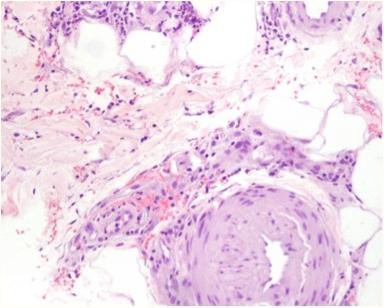 沙门氏菌感染症状的视频,易引起沙门氏菌感染症状