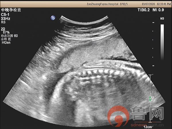 枣庄市妇幼保健院超声科诊断出一例胎儿开放性脊柱裂