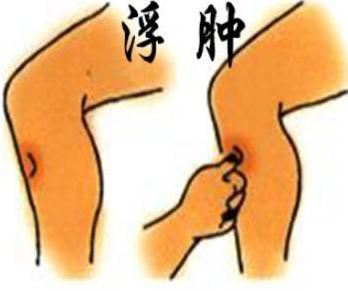 下肢总有水肿怎么回事？名中医王清海教授教你消掉水肿！