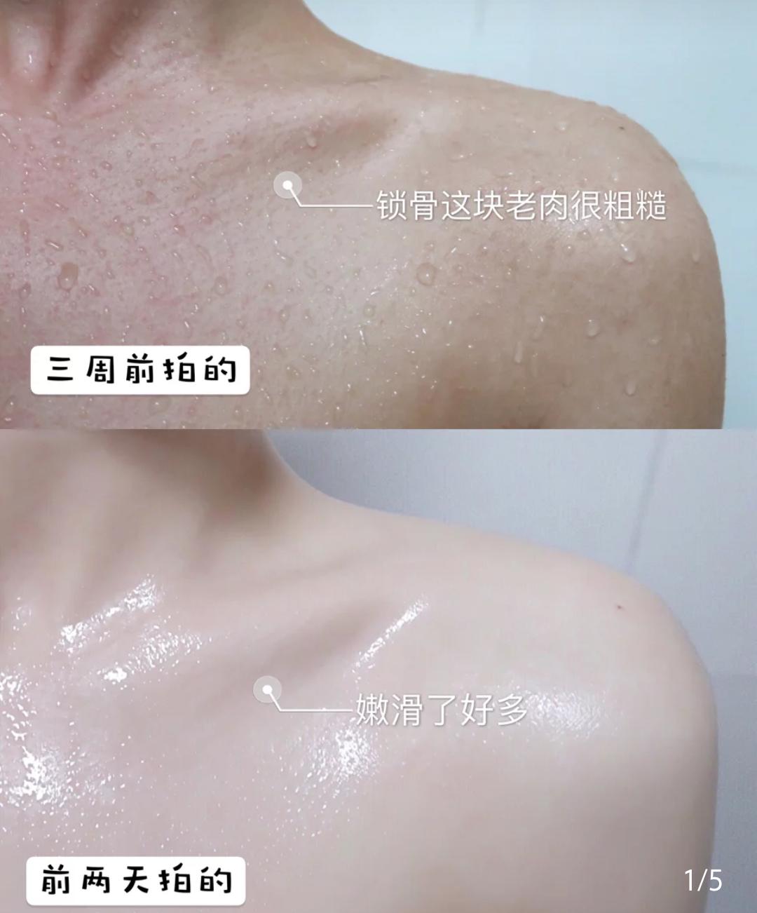 啤酒消痘痘,喝啤酒会消除痘痘吗