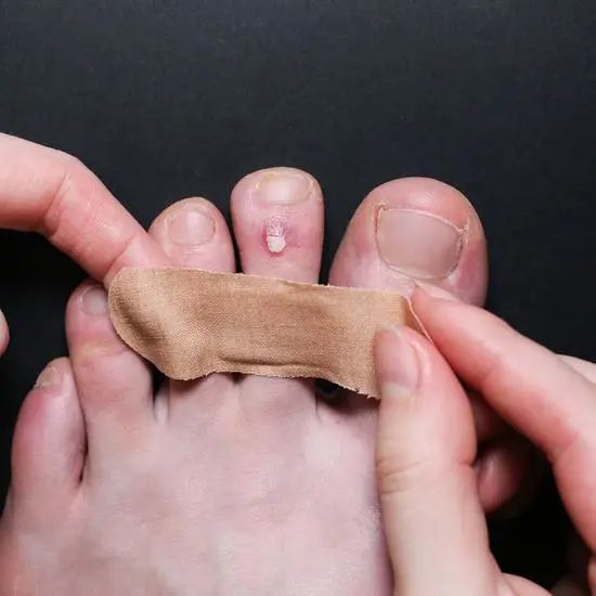 如何预防跑步脚掌起水泡,跑者必须避免的5个错误