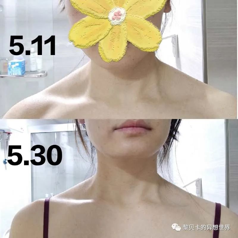 做完医美真的能换脸吗,做完医美需要注意什么