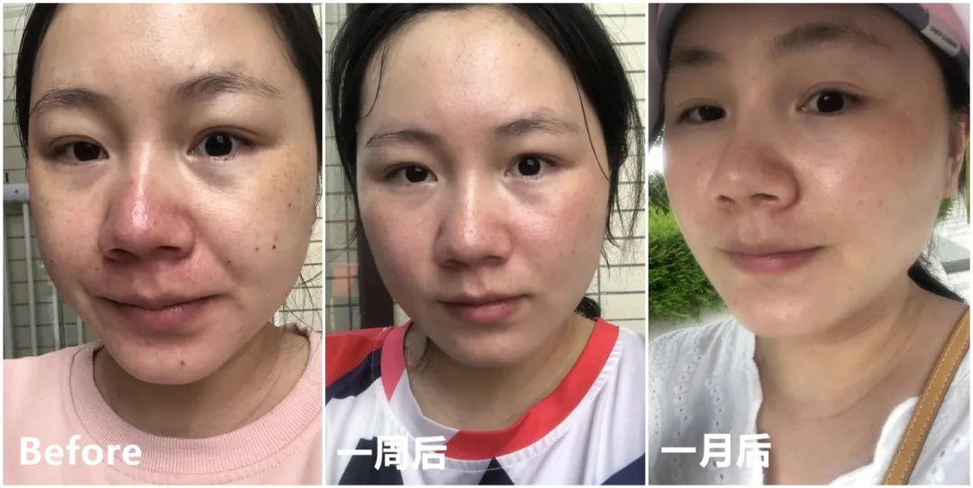 做完医美真的能换脸吗,做完医美需要注意什么