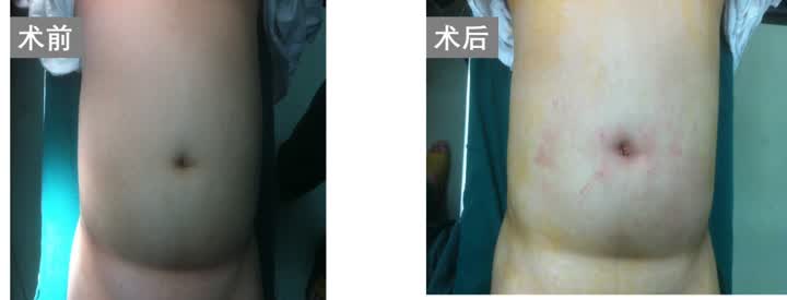 单孔腹腔镜术后一个半月伤口不好,单孔腹腔镜无疤痕
