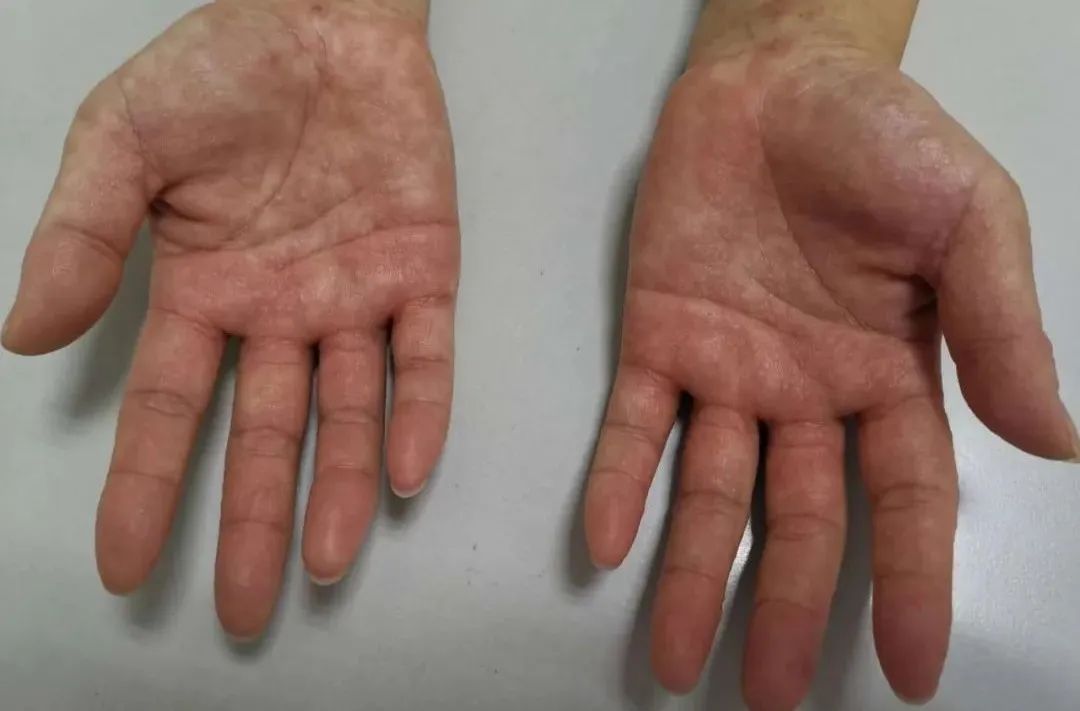 长痒痒的小水泡可以挤吗,小水泡很痒怎么快速止痒