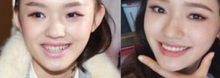 好羡慕别人有一口好牙齿,早日拥有一口整齐更漂亮的牙齿