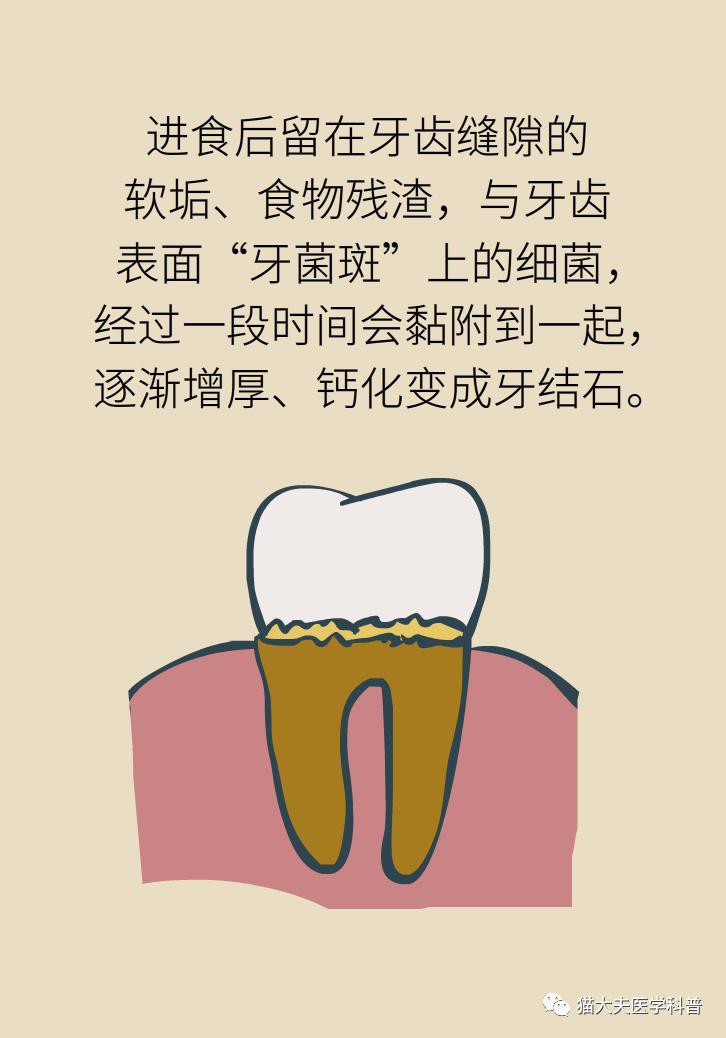 胆结石肝上也有结石怎么办,胆结石胆管里面有结石怎么办