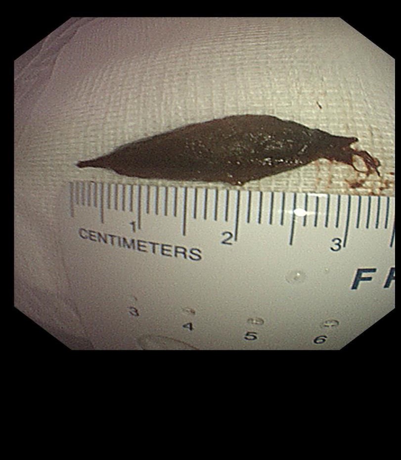 老年人吃粽子后吞食枣核怎么办,吃粽子吞了个枣核