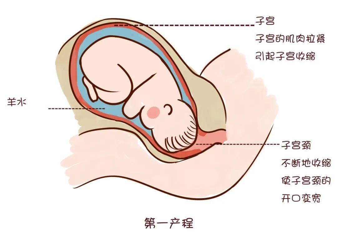 麻醉全过程医学科普,分娩镇痛是哪种麻醉