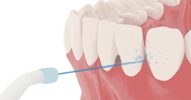明星网红都在带货的水牙线，牙医自己会用吗？快报记者询问了12位口腔医院医生，他们最推荐这两个工具