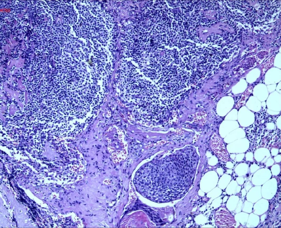 【关注】“为什么是我？！”广东一女子乳腺癌刚痊愈，又发现患上宫颈癌……