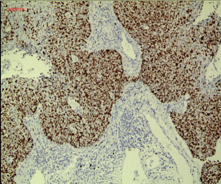 【关注】“为什么是我？！”广东一女子乳腺癌刚痊愈，又发现患上宫颈癌……