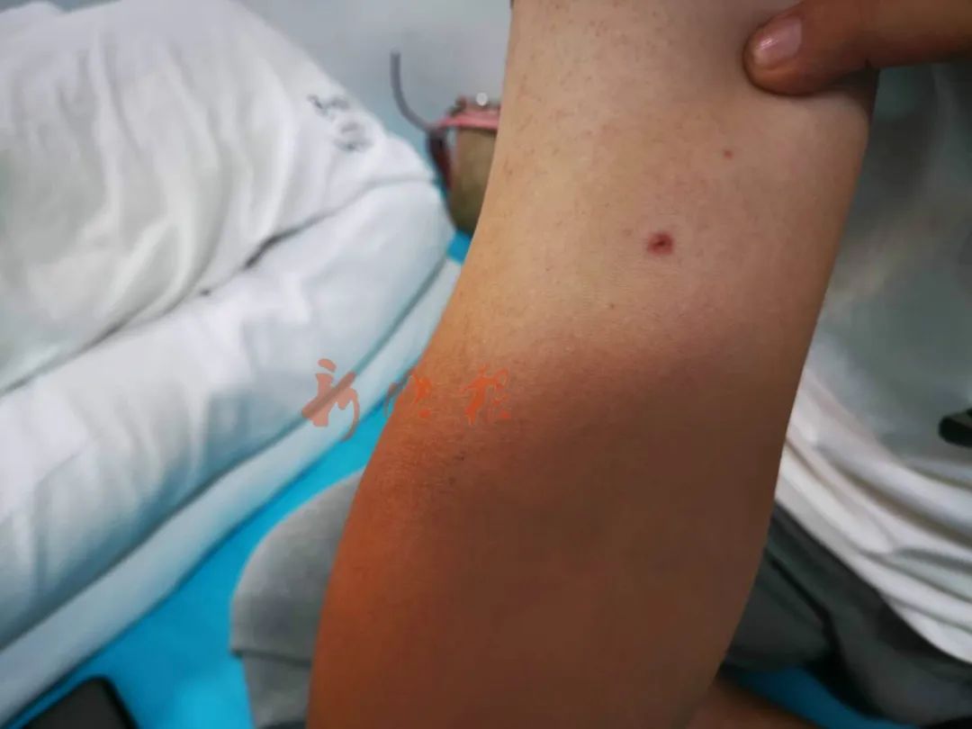 哈尔滨一男子遭蜜蜂“自杀式袭击”，身上拔下40多个蜂针...