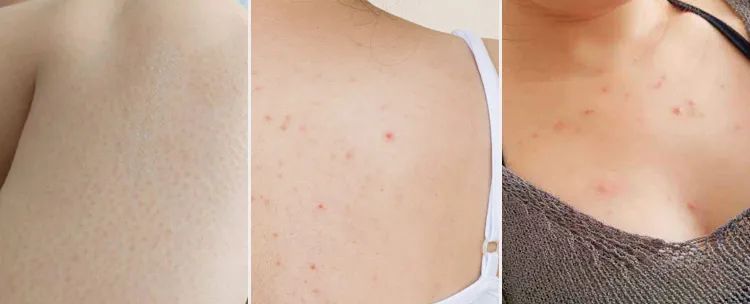 三伏天艾草熏后背多久熏一次,三伏天用艾草泡澡几天泡一次