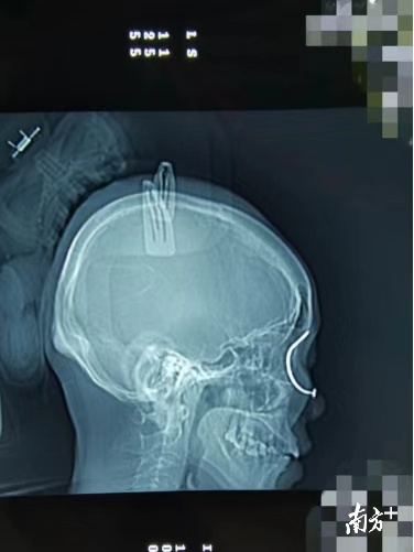 惊悚！佛山一妇女工作时不慎被8cm生锈铁钉穿眼