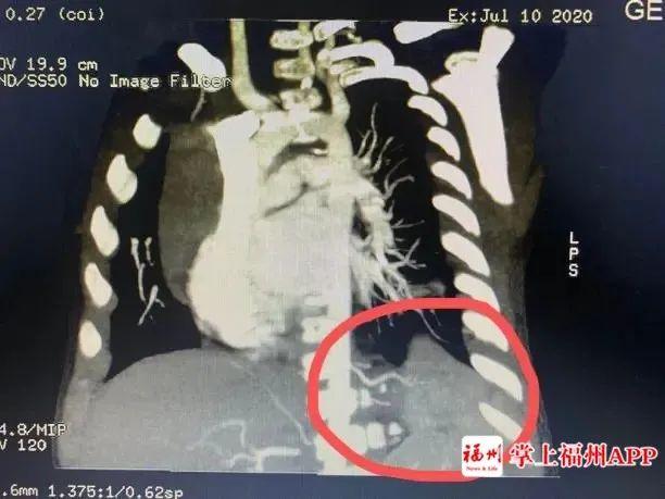 5个月宝宝咳嗽反复发烧38.5,8岁孩子反复发烧咳嗽厉害持续5天