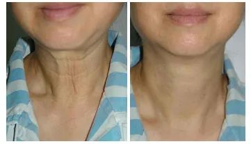 一条颈纹老十岁教你一招淡化,女人脖子有颈纹和年龄有关吗