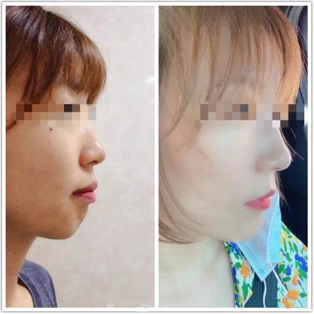 昆明龅牙矫正要多少钱,长沙轻微龅牙矫正要多少钱