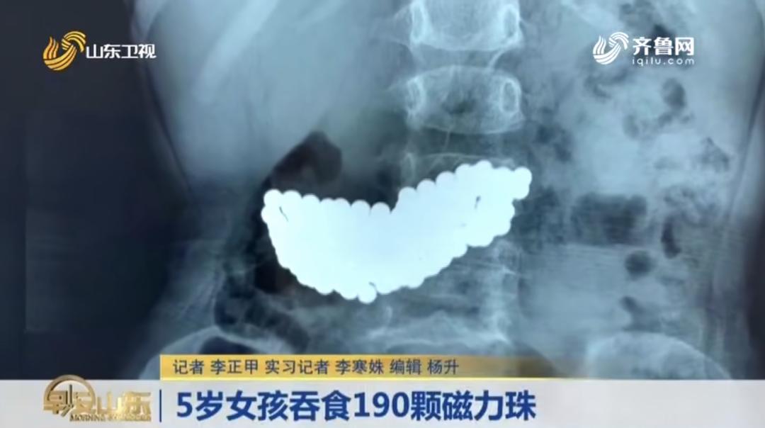 两岁女孩误吞下17颗磁力珠,宝宝吞下四五颗磁力珠怎么办