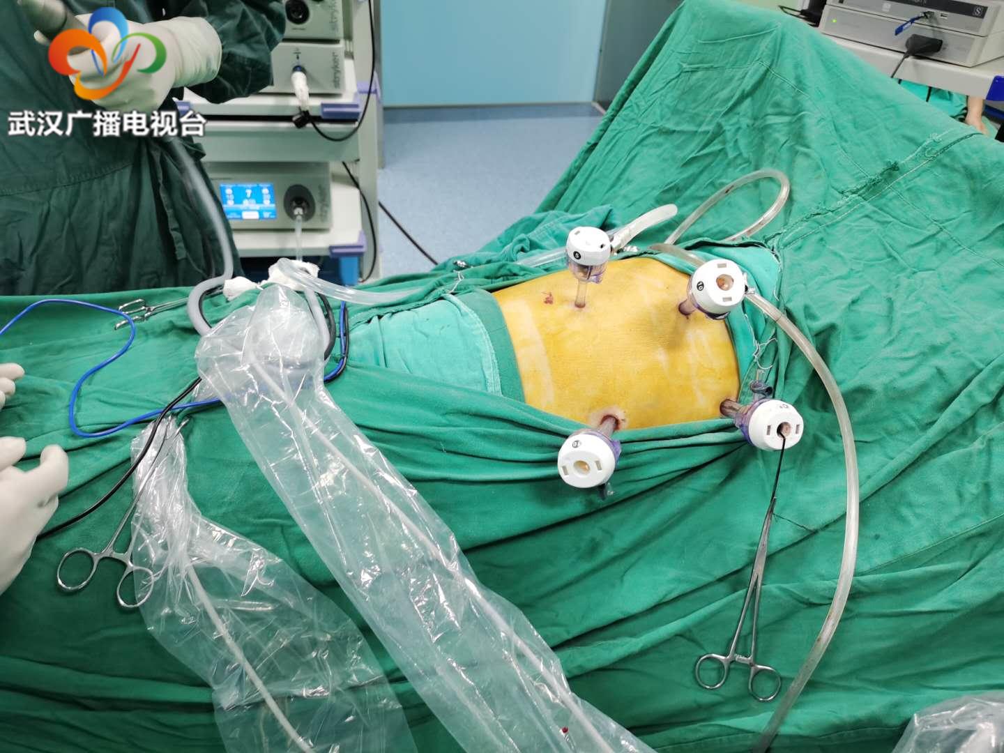 协和医院食管癌最新治疗,协和医院治疗食管癌新技术