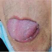 新冠肺炎引起冠心病,新冠医案