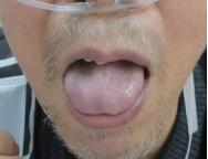 新冠肺炎引起冠心病,新冠医案