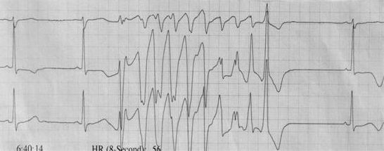 室速属于重大疾病吗,室速的相关资料