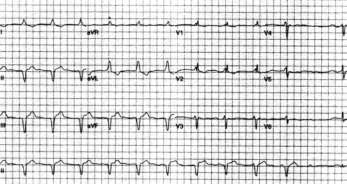 室速全名叫什么,室速的解读和识别
