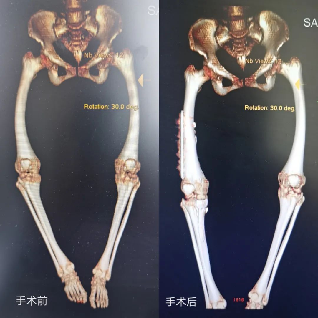 截骨手术是什么手术全过程,截骨矫形手术全过程