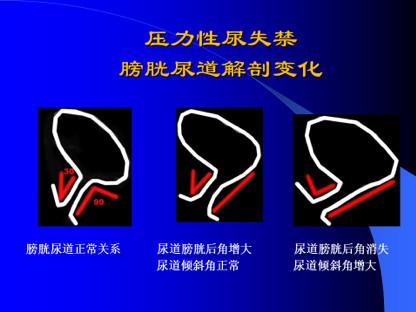 笑尿了也是一种病听听专家怎么说,笑尿了具体是什么病