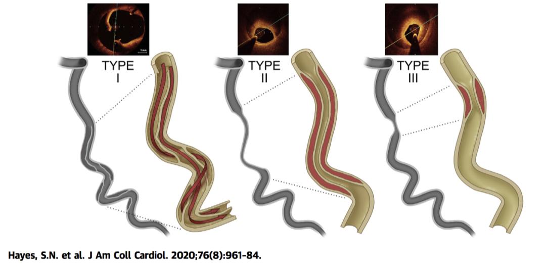冠状动脉夹层症状和治疗,自发性冠状动脉夹层斑块破裂