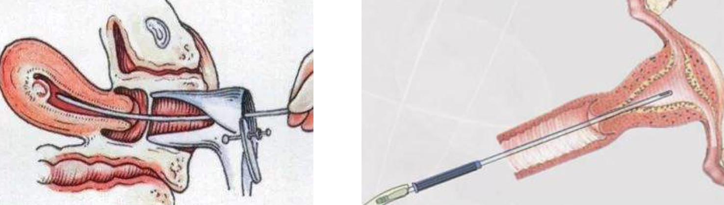 怀孕时宫腔粘连怎么办,宫腔粘连怀孕出血流产