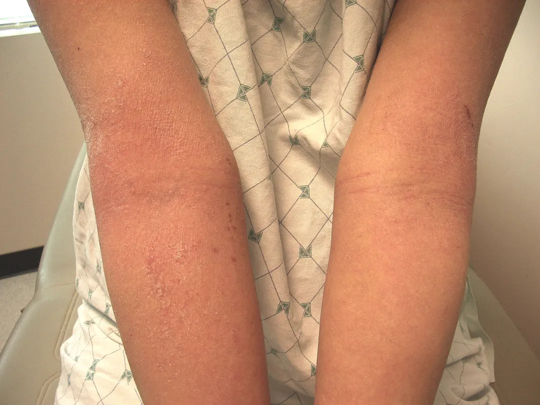 儿童特应性皮炎几岁自愈,儿童特应性皮炎自愈年龄统计