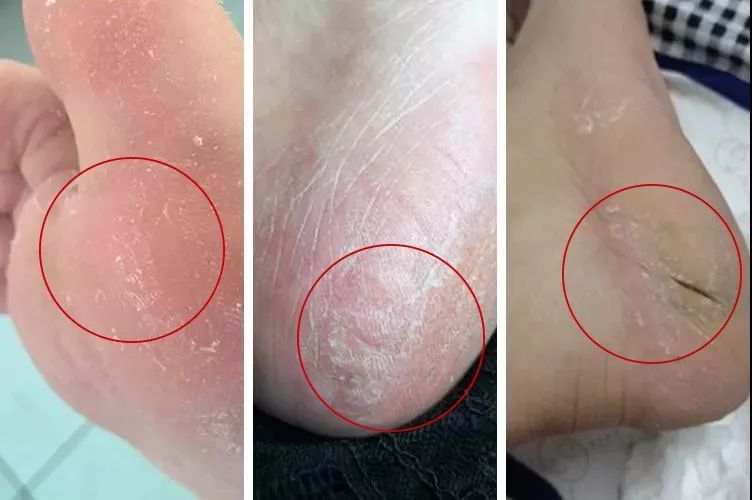 你穿高跟鞋经历过磨脚的痛苦吗,穿高跟鞋脚掌死皮怎么去除