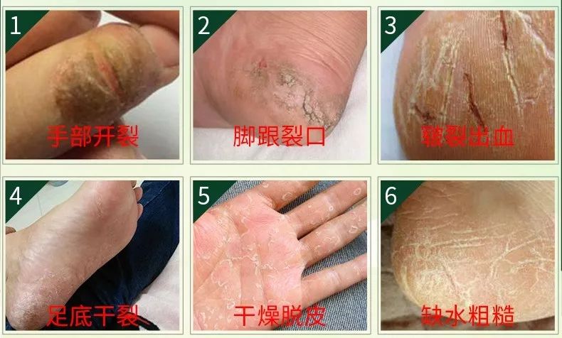 你穿高跟鞋经历过磨脚的痛苦吗,穿高跟鞋脚掌死皮怎么去除