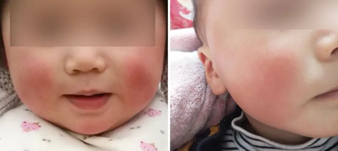 冬天宝宝脸干燥可以涂什么护肤品,儿童护肤冬季防皲裂