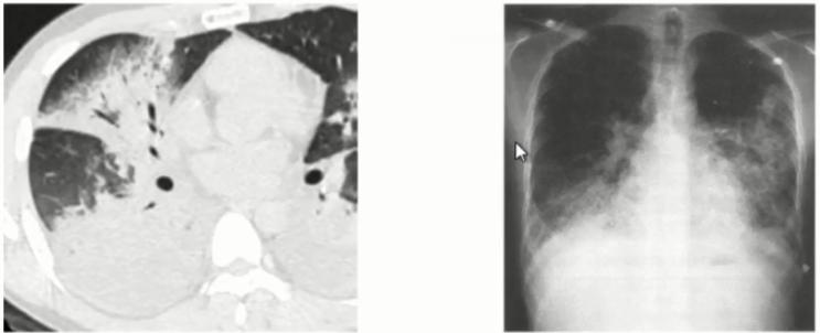 支原体肺炎症状中医诊治,成人肺炎支原体肺炎诊治专家共识