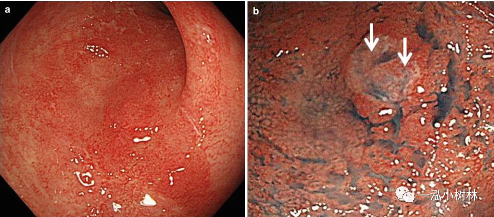 炎症性肠病内镜下表现,炎症性肠病早期筛查结果