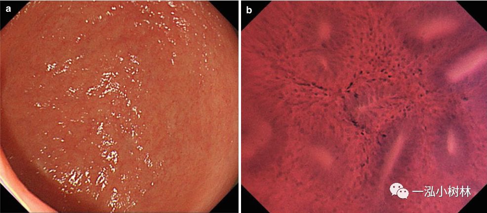 炎症性肠病内镜下表现,炎症性肠病早期筛查结果