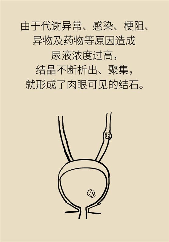 结石发作吃什么能缓解,结石每天都痛怎么办