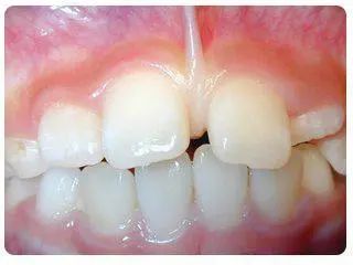 大人的上唇系带,上唇的系带太长