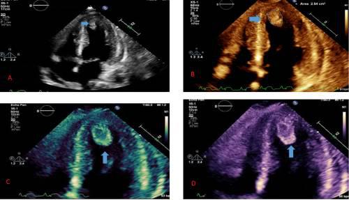 胳膊疼了一晚上是心梗吗,腿疼就是心梗吗