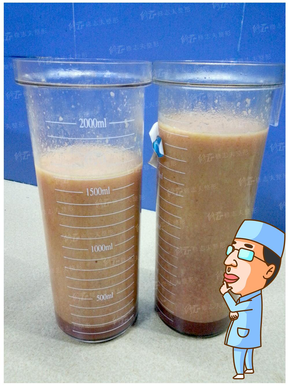 抽出来的脂肪为什么是液体,抽出来的脂肪去哪里了